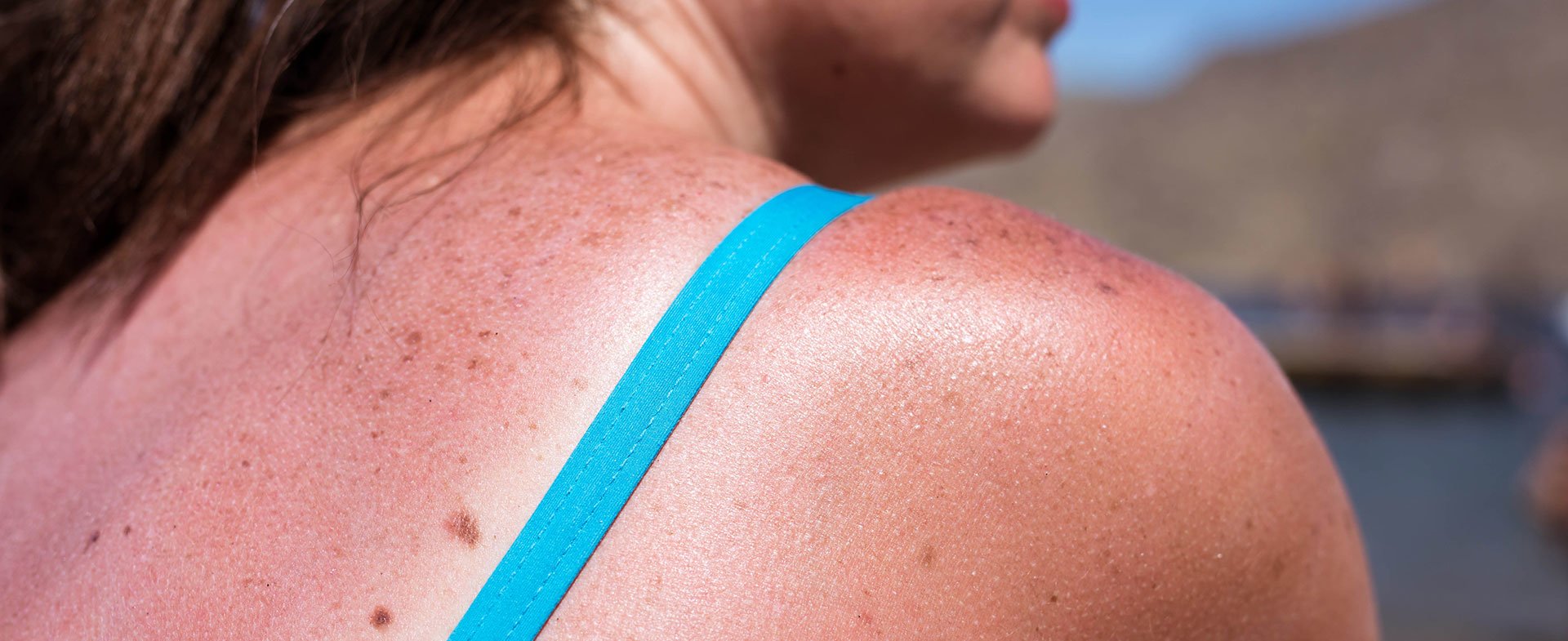 Sunburn Basics Take The Sting Out Of Sunburn Henry Ford Health