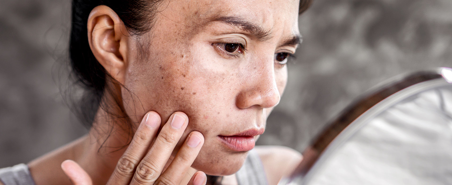 How to Remove Dark Spots Caused by Pimples: Dermatologist Explains