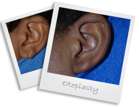 otoplasty1