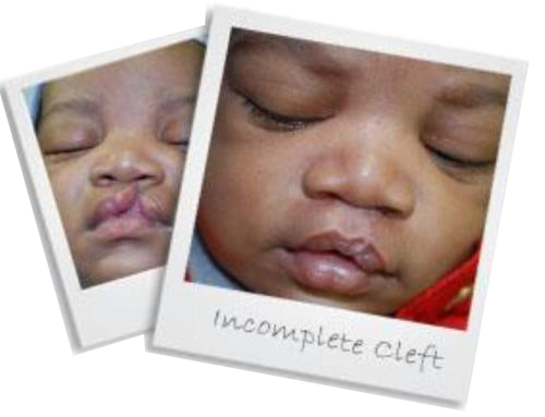 incompletecleftsmall