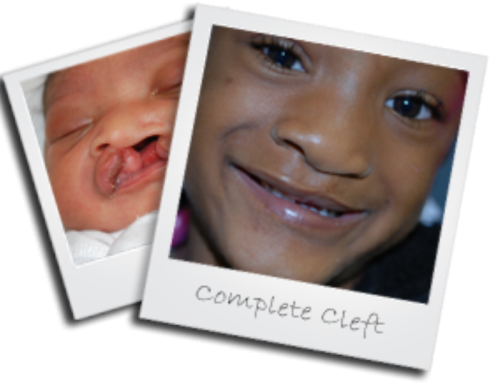 patient1 cleft